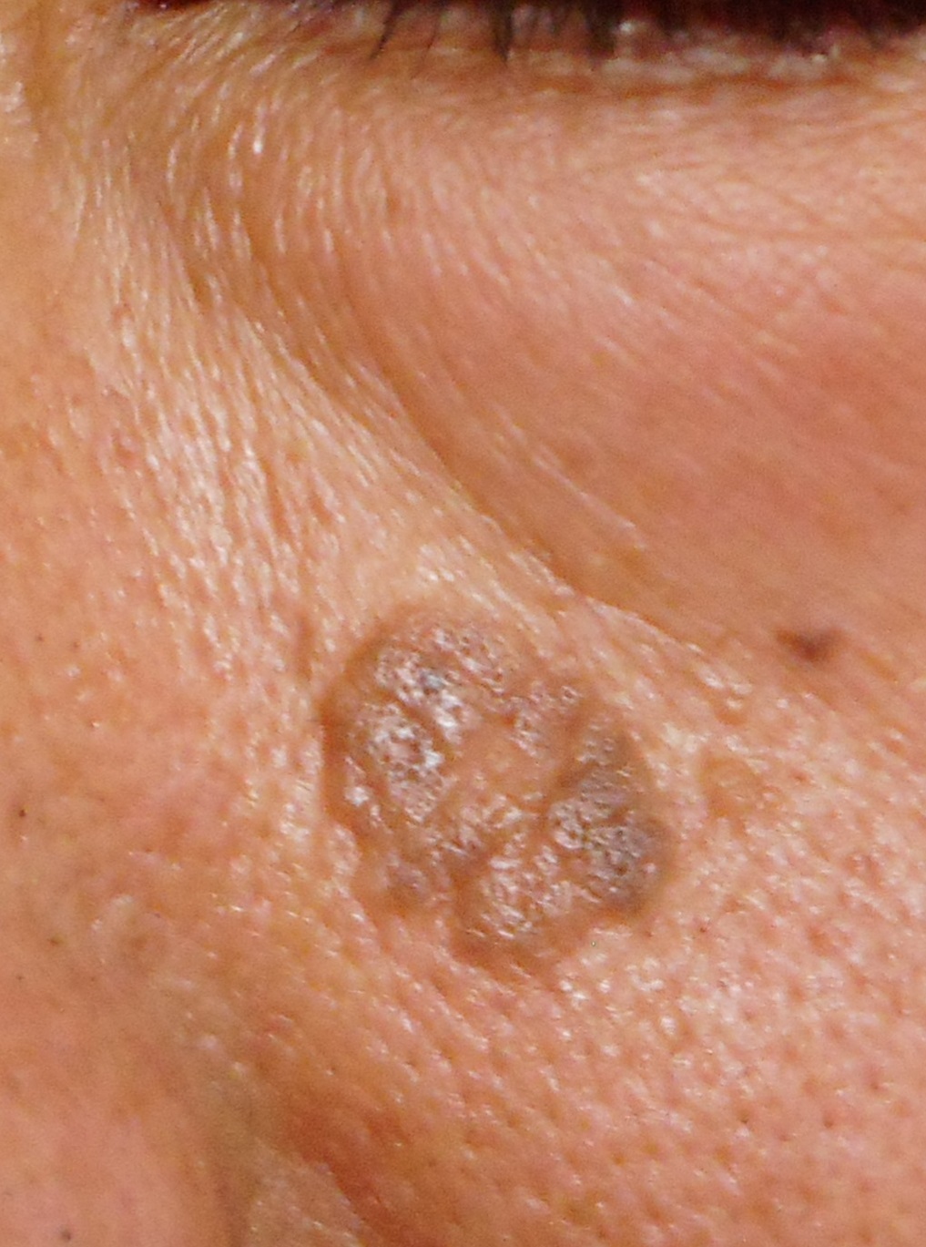 いぼ、老人性イボ|王子駅の皮膚科|シマダ皮膚科クリニック いぼ、老人性イボ|王子駅の皮膚科|シマダ皮膚科クリニック