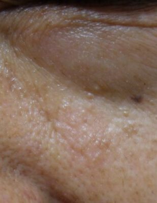 老人性イボを炭酸ガスレーザーで処置後（2週間経過）