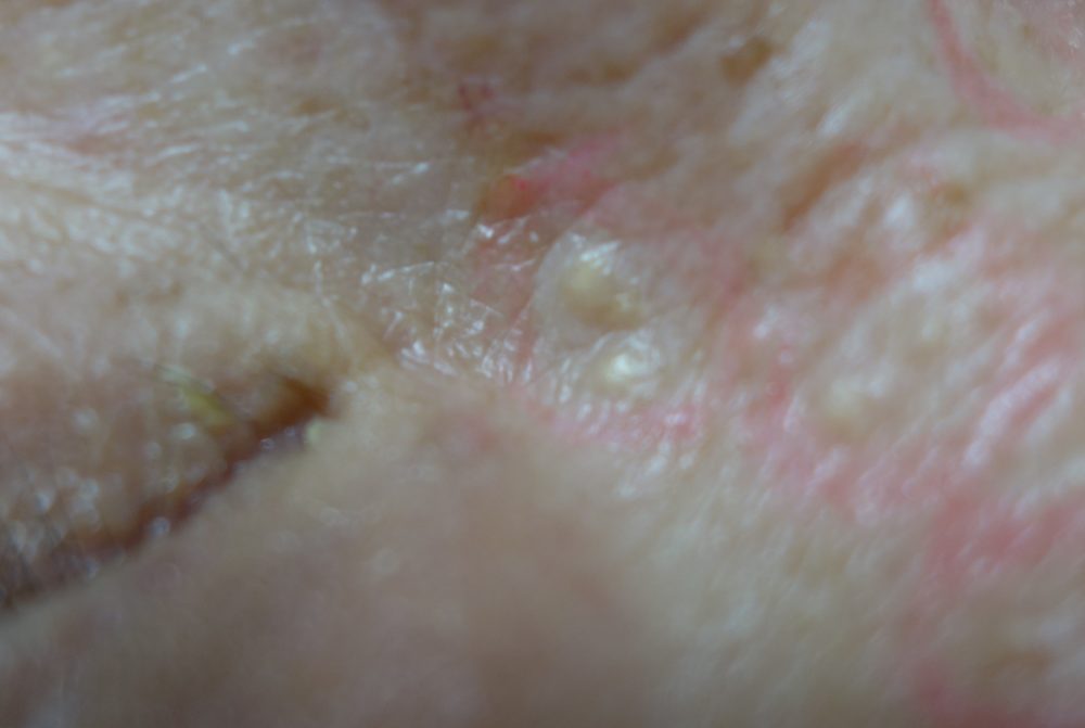 稗粒腫（はいりゅうしゅ）