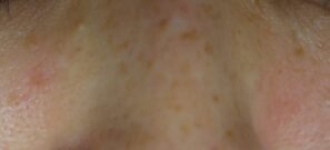 炭酸ガスレーザー処置直後