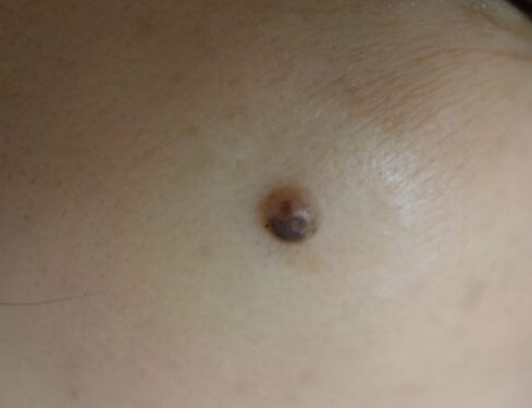症例：右頬部のほくろ