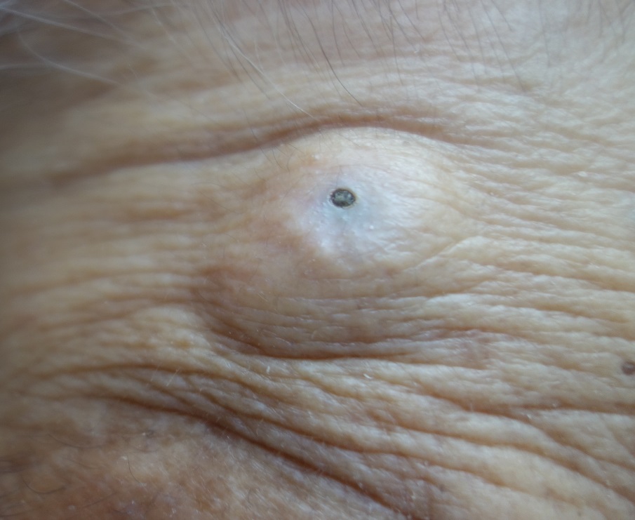 粉瘤（ふんりゅう）