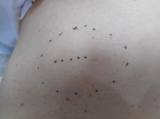 脂肪種（しぼうしゅ）