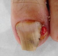 巻き爪、陥入爪