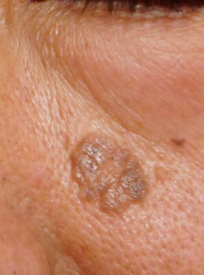 老人性イボを炭酸ガスレーザーで処置後