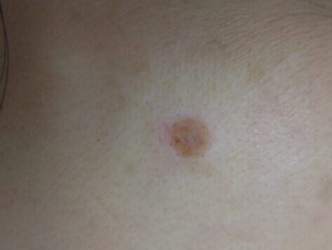 症例：炭酸ガスレーザー治療直後