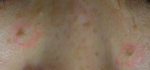 左右頬の老人性イボ（ピンクでマーキング）