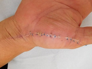 ケガ（切り傷、擦り傷）