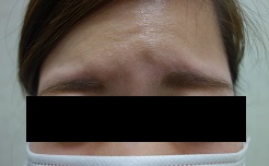 ボトックス注射 注射後2週