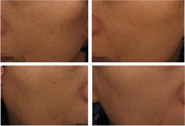 IPL光治療によるシミの経過