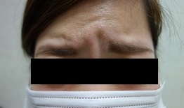 ボトックス注射 注射前