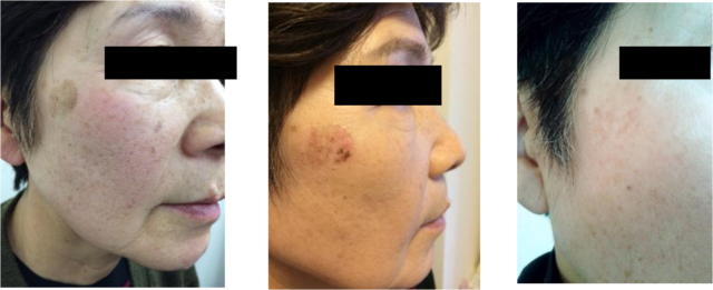 Qスイッチレーザー治療によるシミの経過