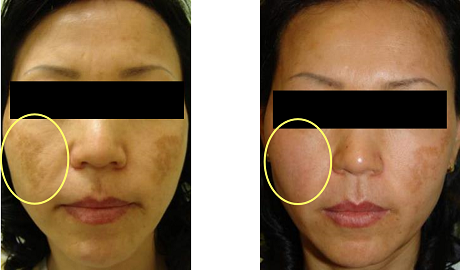 レーザートーニング 施術前後