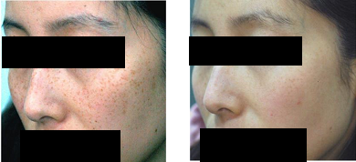 IPL光治療 施術前後