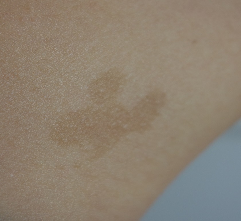 あざ　扁平母斑