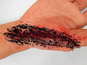 ケガ（切り傷、擦り傷）