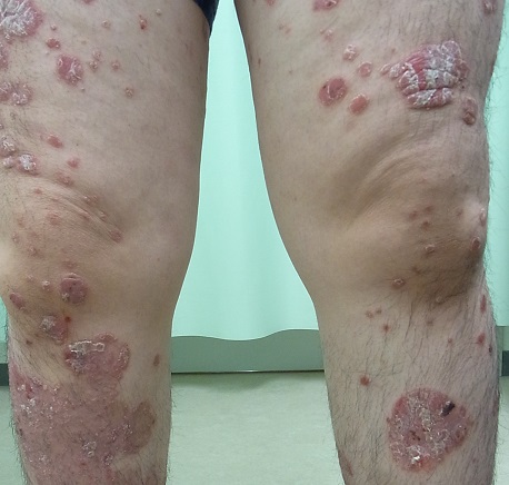 乾癬（かんせん）