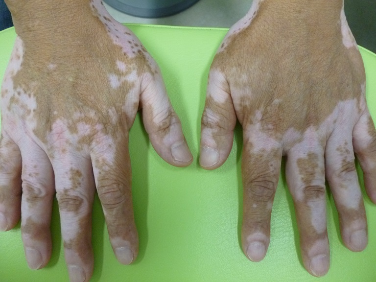 白斑（はくはん）