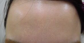 ボトックス注射 注射後