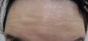 ボトックス注射 注射前