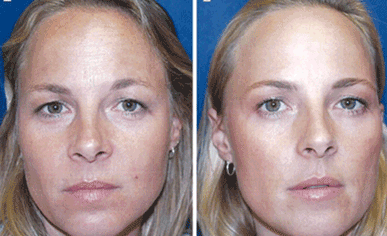 顔のしわ、表情筋の緊張をゆるめる薬剤の注射<br>