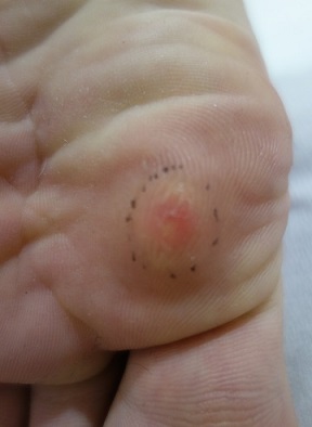 足底の粉瘤