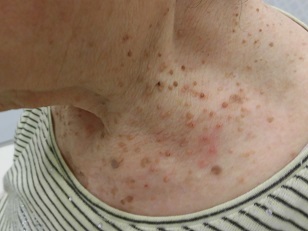 首のいぼ 炭酸ガスレーザー治療前