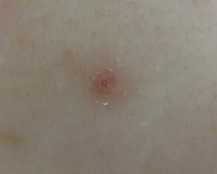 ニキビ注射後（注射後3日）