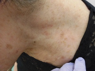 首のいぼ 炭酸ガスレーザー治療後