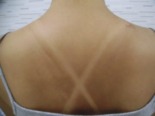 日焼けしちゃった・・・日焼け止めのＳＰＦとＰＡとは？焼けたらどうする？