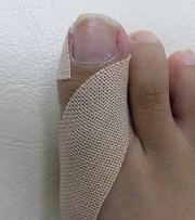 巻き爪、陥入爪治療