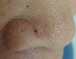 皮膚がん（基底細胞癌）