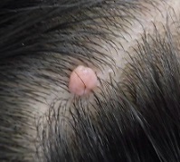 頭部のできもの（ほくろ）