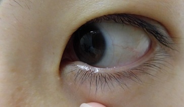 下眼瞼母斑 治療後