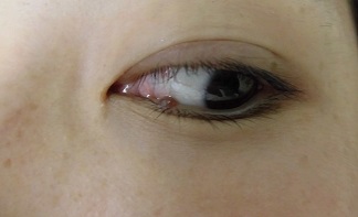 目のまわりのほくろ