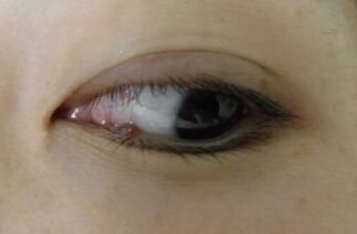 下眼瞼母斑 治療前