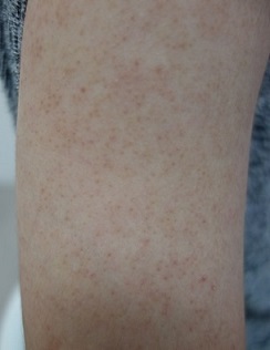 腕のざらざら、毛孔性苔癬（毛孔性角化症）