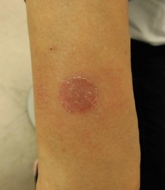 猫カビ、体部白癬