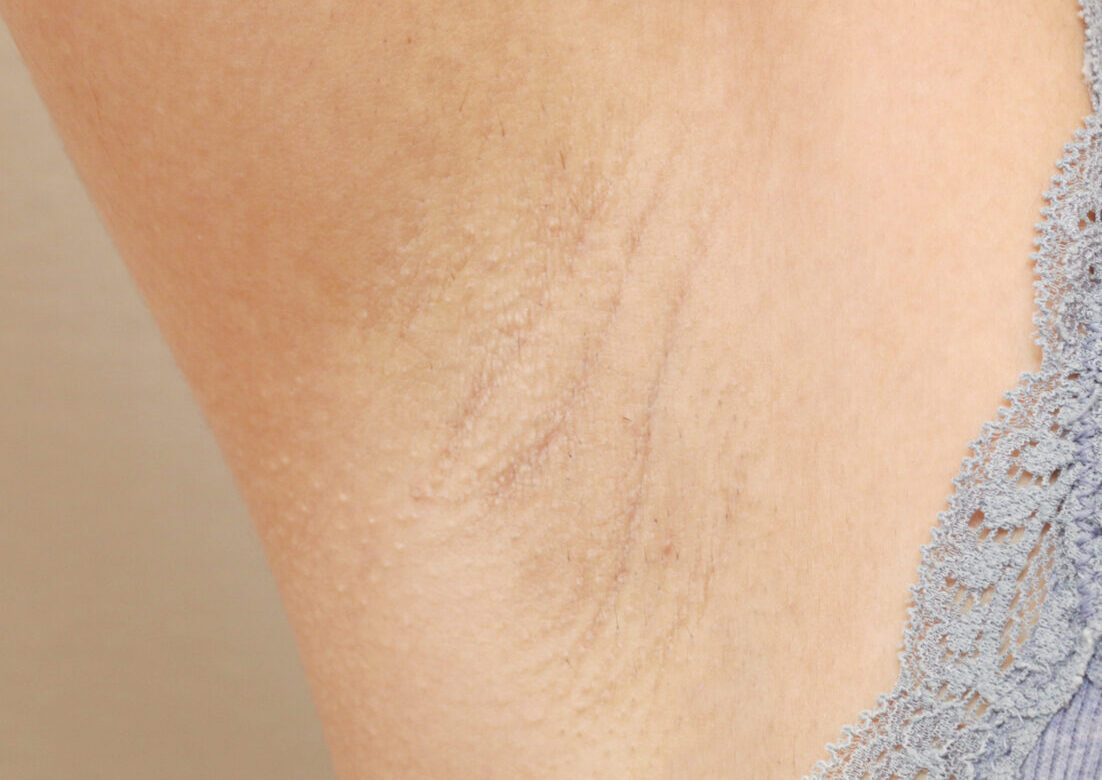 女性 わき医療脱毛 施術後