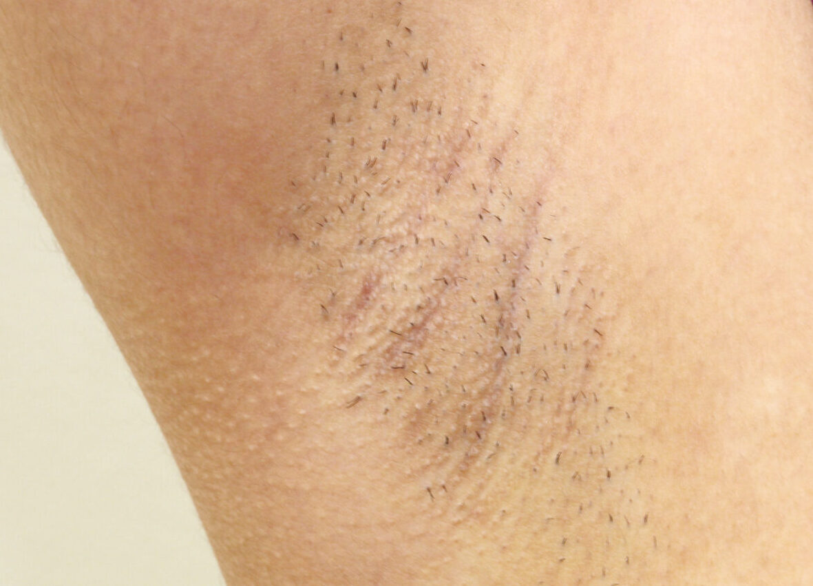 女性 わき医療脱毛 施術前