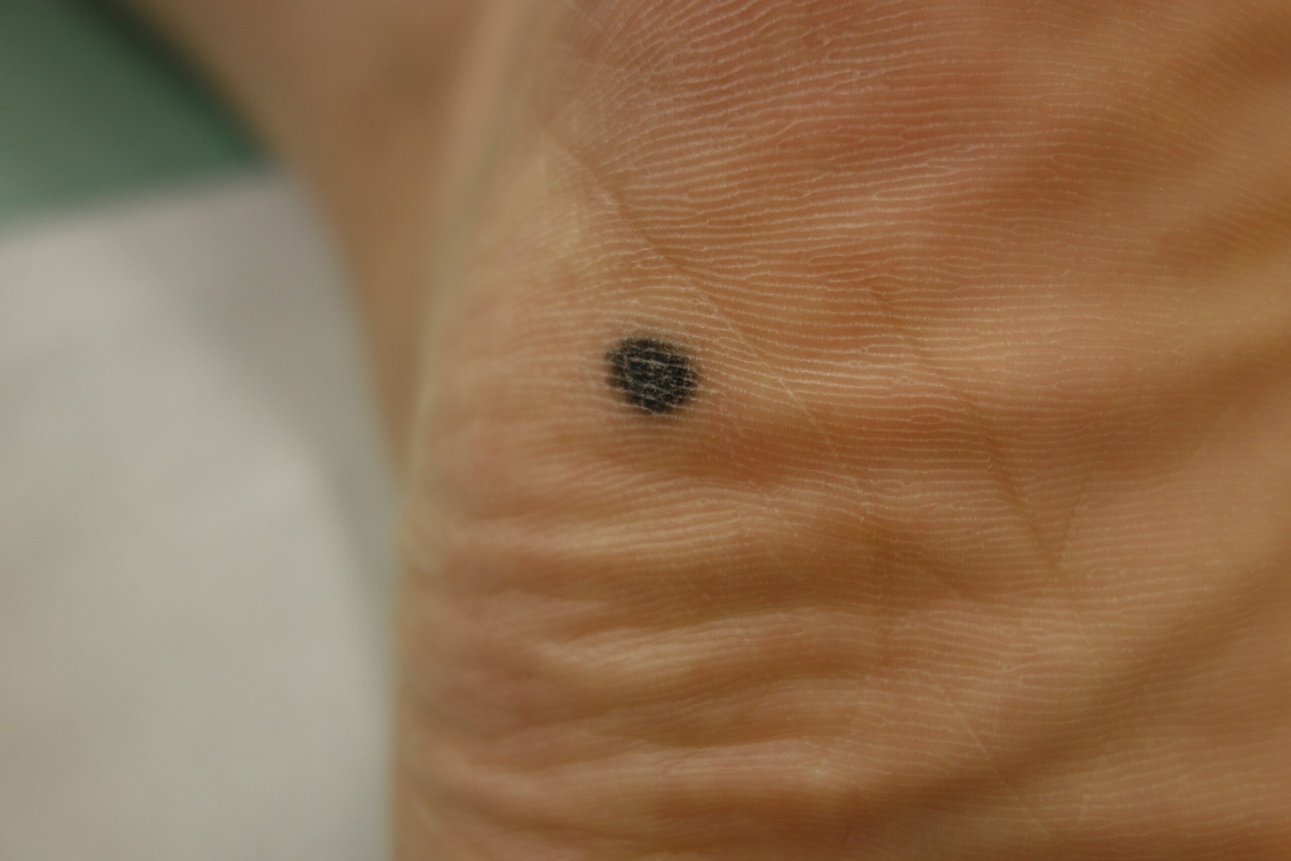 夏だ！レジャーだ！虫刺されは受診だ！