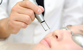 Qスイッチレーザー