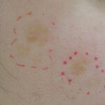 Qスイッチレーザー 照射前