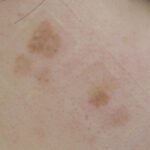 Qスイッチレーザー 照射翌日