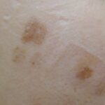 Qスイッチレーザー 照射1週間後