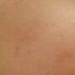 Qスイッチレーザー 照射2週間後