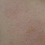 Qスイッチレーザー 照射1ヶ月後