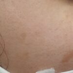 Qスイッチレーザー 照射1年後