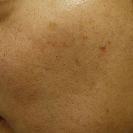 IPL光治療 施術前