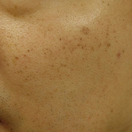 IPL光治療 施術後